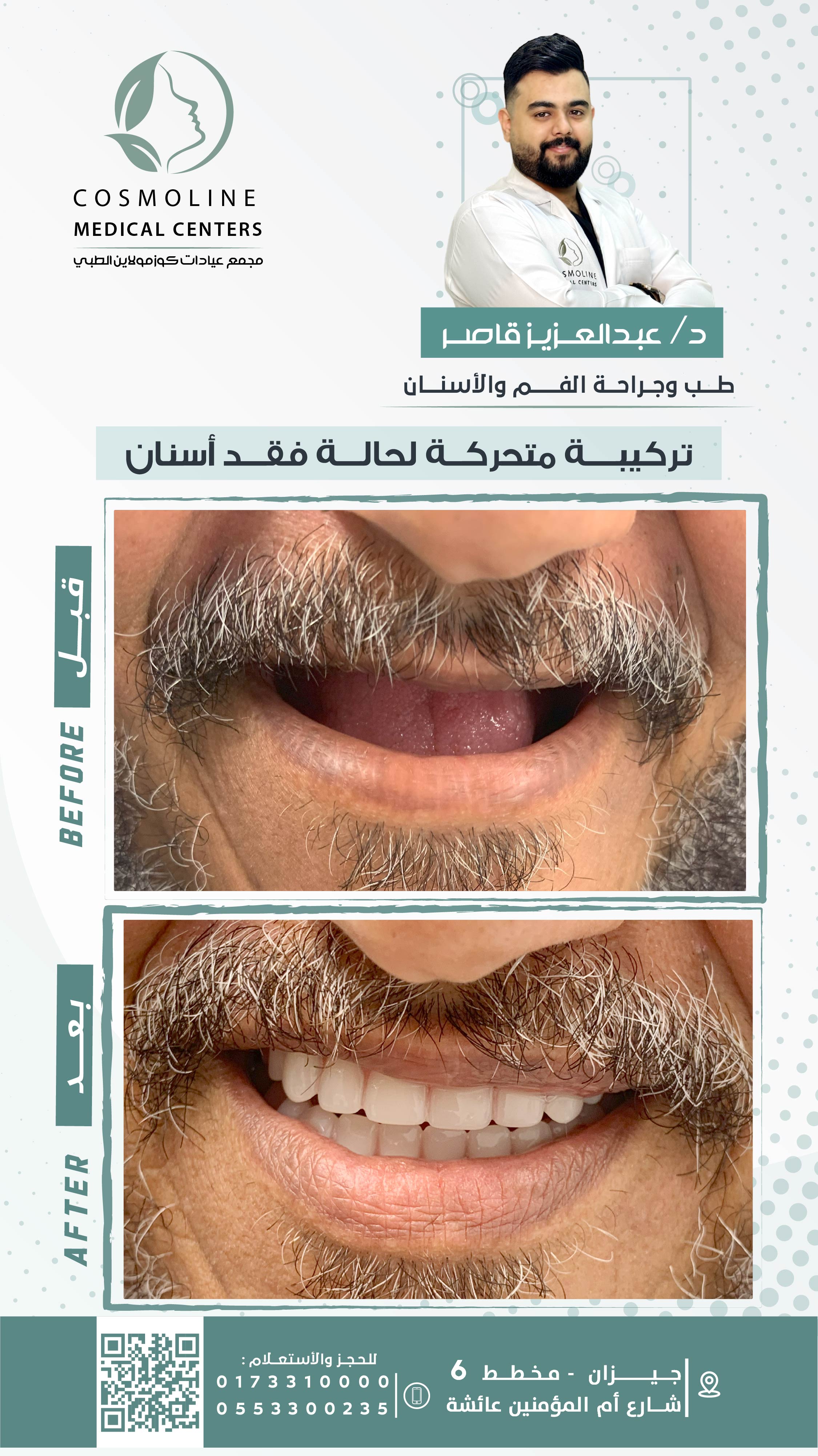 تركيبة متحركة لحالة فقد أسنان